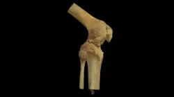 R Knee w Ankylosis (VCU_3D_3973)