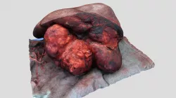 Right lobe liver specimen