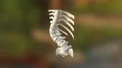 Scoliosis Print