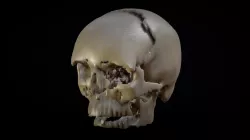 Skull CT Scan