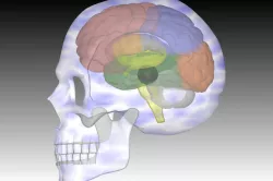 Cavernous Haemangioma-With Brain & Skull in Autocad 3D