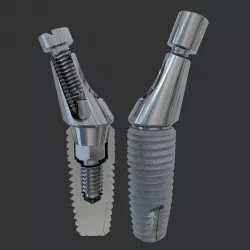 Angular abutment and sectional implant 3D model