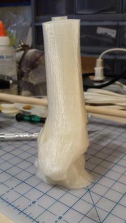 tib fib fracture 3D Models | Page 1 | STLFinder