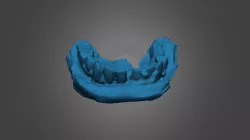Dental Impression