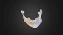 mandibula +intraoral sken +kondylarne chrup.