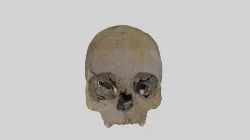 Skull of a 5-6-year old boy with four traumata