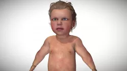 Measles