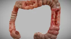 Crohn's Disease
