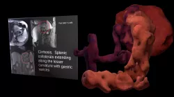 Gastric Varices