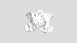 Iliac Angiography CT scan model