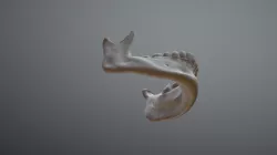 Mandible CT Scan Extraction