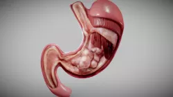 Stomach Cancer
