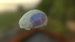Cranio Reconstruction Case#5
