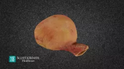 Stomach Adenocarcinoma 180424