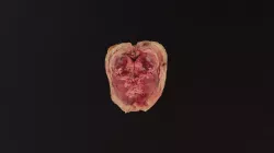Kidney Tumor 1 - DS2