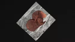 Lung Tumor 2