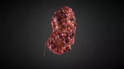 Polycystic Kidney