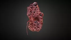 Polycystic Kidney Cross-section