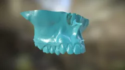 Maxillary Constriction | BioModel