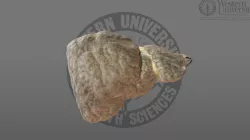 3000104 Liver Cirrhosis