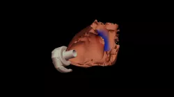 Septal view