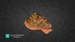 Gallbladder Multiple Stones 151331