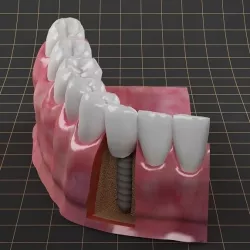 Dental Implant  01 3D model