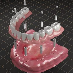 Dental Implant  02 3D model