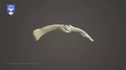 Silicone PIP Finger Joint Replacement