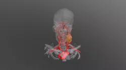 ct scan