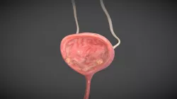 Bladder cancer