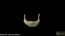 Hyoid