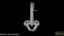 Ankylosing Spondylitis