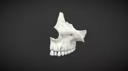 maxillary simple / Maxilar Simple