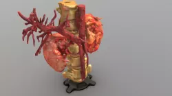 Kidney Disease