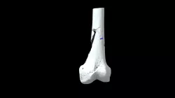 Femur with gunshot wound