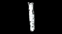 Right tibia with osteomyelitis (VCU_3D_5293)