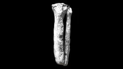 Tibia/fibula with osteomyelitis (VCU_3D_5292)