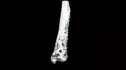 Tibia with actinomycosis (VCU_3D_5289)