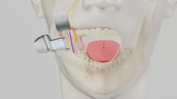 BSSO: Medial Osteotomy
