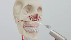 Le Fort 1 Step 3: Septal Osteotomy