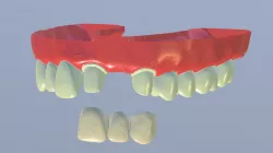 Provisional FPD on Teeth #9 to 11
