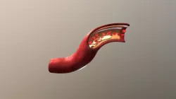 Arteria