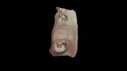 Rib Bond Bridge Prep Cast STL