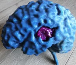 MRI Brain