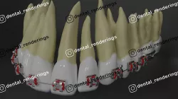Orthodontic braces - Upper teeth - High res 3D model