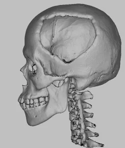 My Skull defect from car accident STL from CT Scan data 3D model