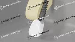 Dental implant crown 3D model