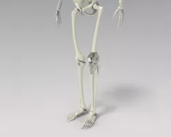Knee Tumor Prosthesis 3D model