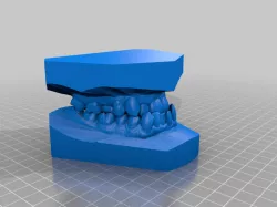  My class III Malocclusion (underbite)